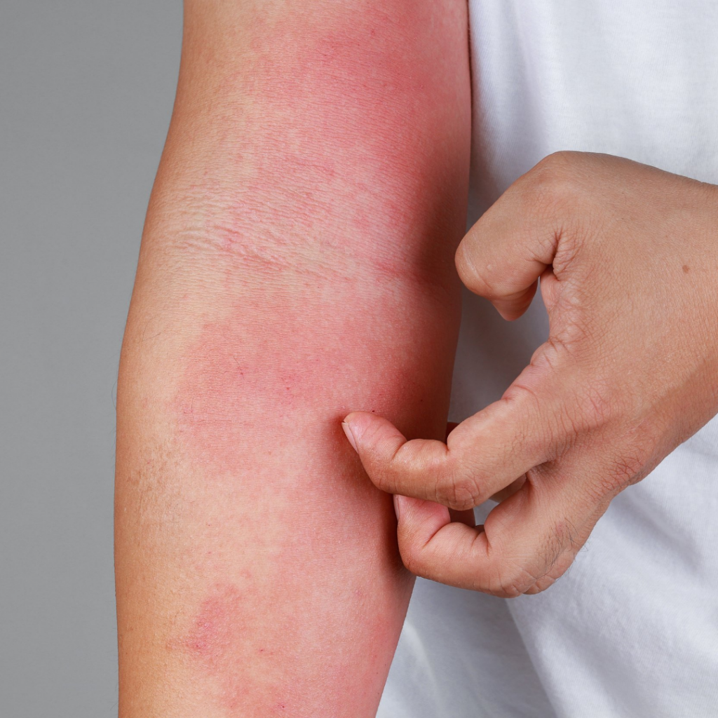Eczema Skin Condition