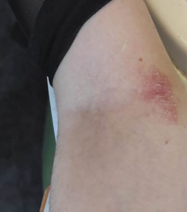 Customer's inner elbow - Picture taken 04/02/2022