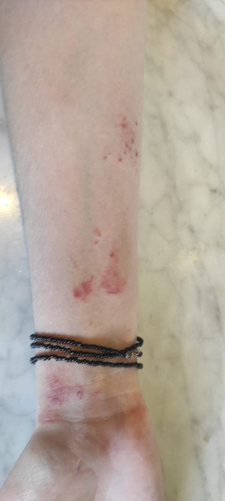 Customer with severe allergies - Picture Taken 04/02/2022